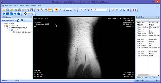 MicroDicom viewer